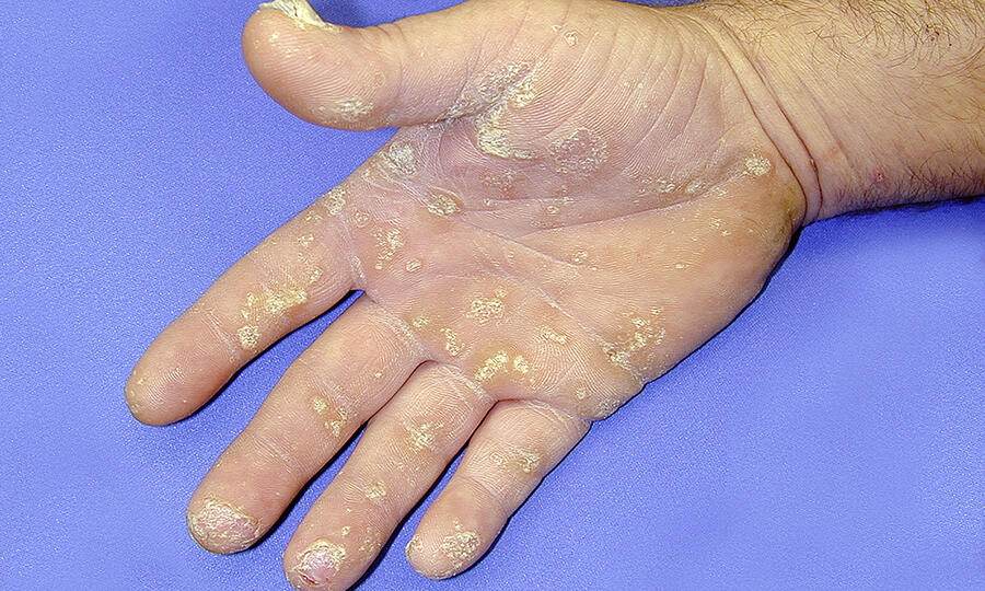 Psoriasis arthritis symptome